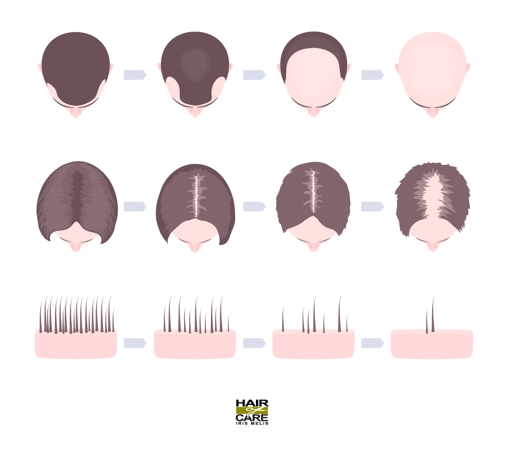 Alopecia Androgenetica