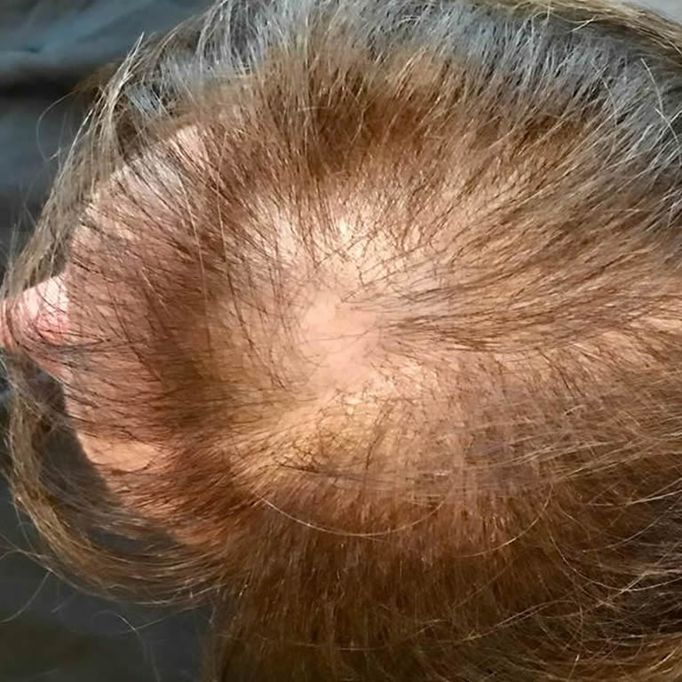 Alopecia androgenetica